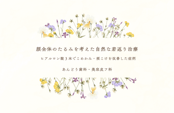 【40代女性】ヒアルロン酸3本でこめかみ・頬のこけを改善した症例｜顔全体のたるみを考えた自然な若返り治療