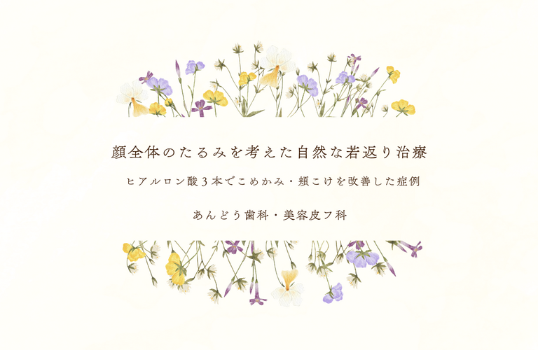 【40代女性】ヒアルロン酸3本でこめかみ・頬のこけを改善した症例｜顔全体のたるみを考えた自然な若返り治療